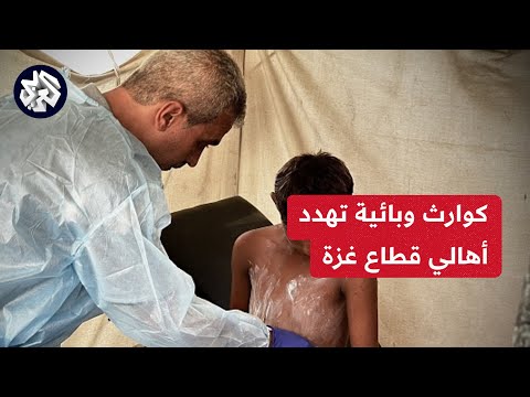 وزارة الصحة الفلسطينية تحذر من كارثة وبائية نتيجة تفشي الأمراض في غزة   التلفزيون العربي