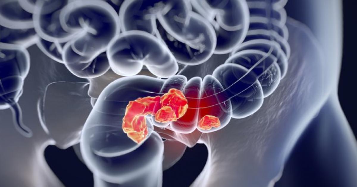 The cause is “unknown”. A study warns of an alarming increase in colon cancer